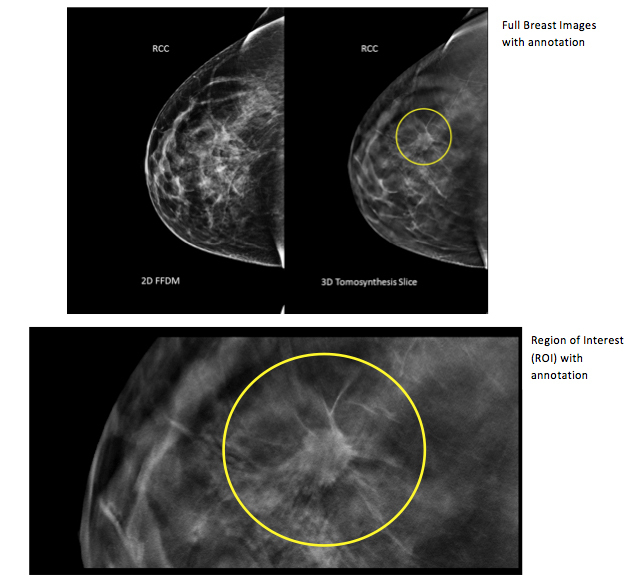La mammographie par IRM devrait permettre d'améliorer le dépistage du cancer du sein.
