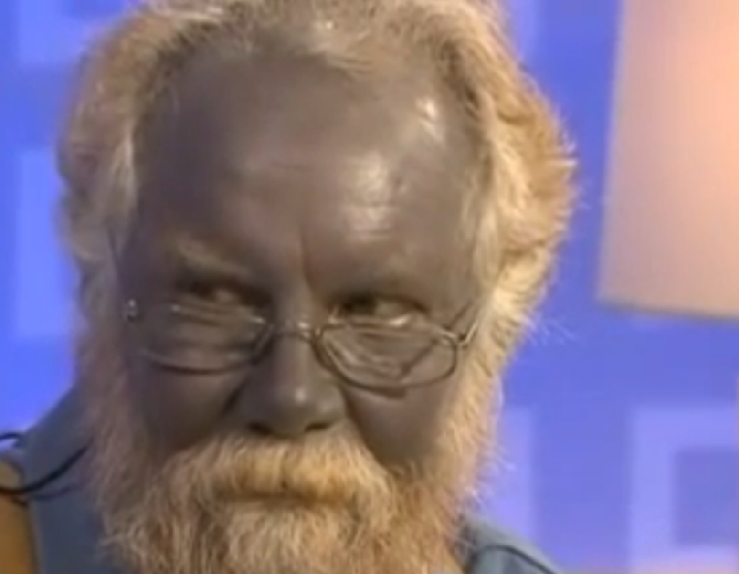 Paul Karason est décédé. Il était célèbre pour sa peau bleue. 