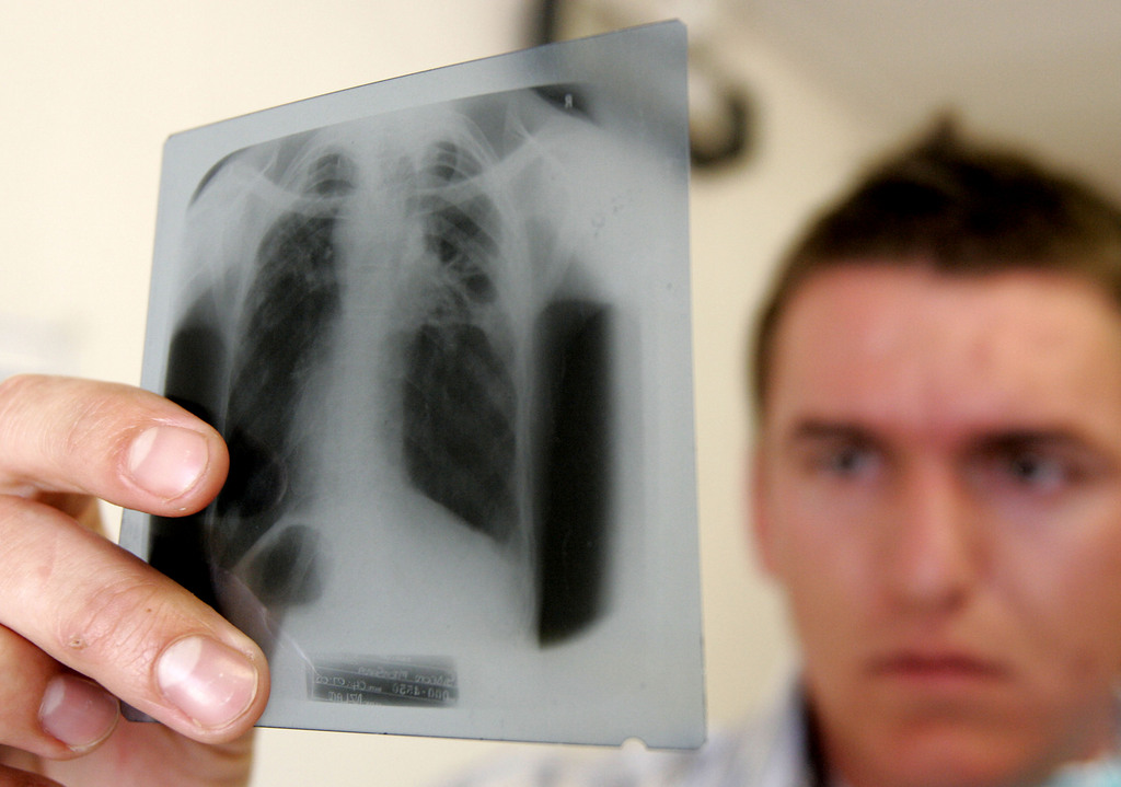 Si le test pour détecter la tuberculose est positif, une radio des poumons permet de déterminer le stade d'avancement de la maladie.