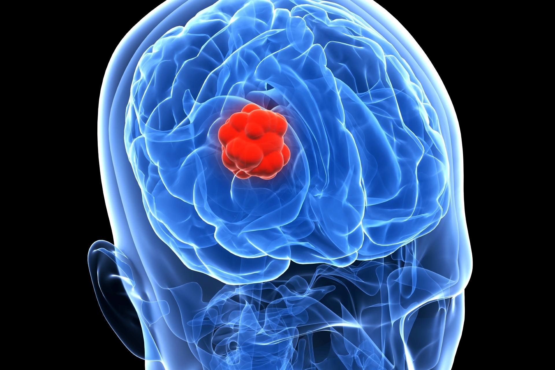 Une tumeur, présente dans le cerveau de la patiente depuis une trentaine d'années, est à l'origine de ces "voix divines".